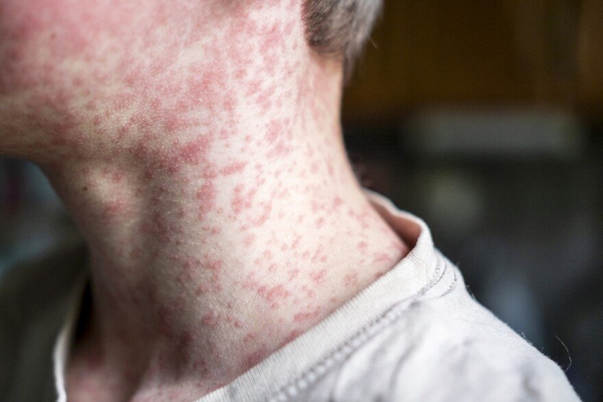 Measles viral disease, human skin covered with measles rash