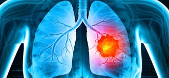 Pfizer’s Lorbrena extends life for patients with ALK-Positive Advanced Lung Cancer